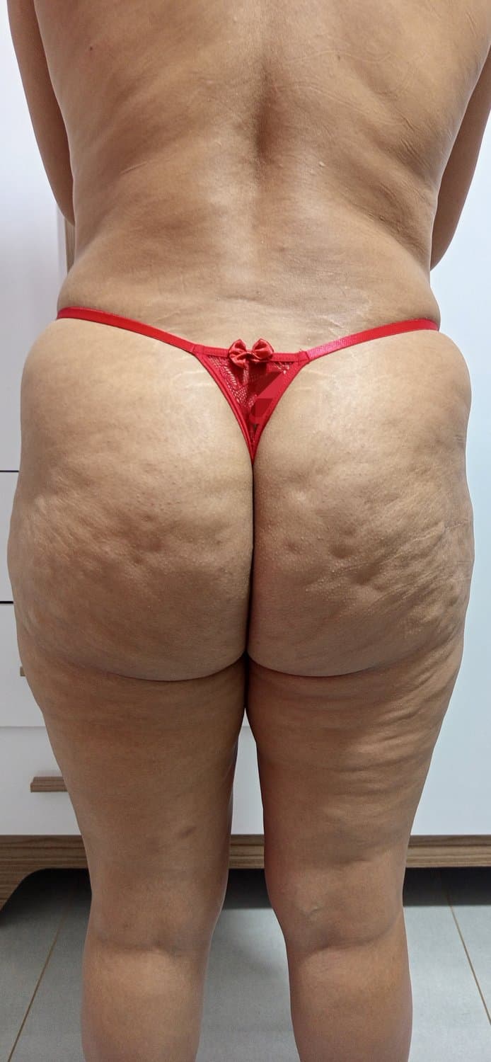 Celulite do bundao da esposa