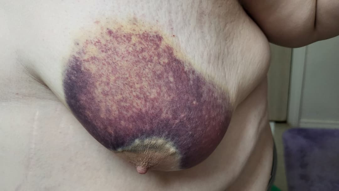 Heavy BDSM Brusing Over A Week