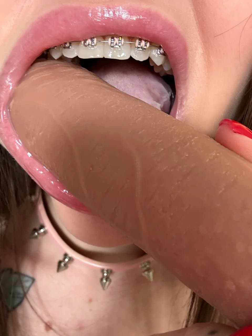 Teen Braces