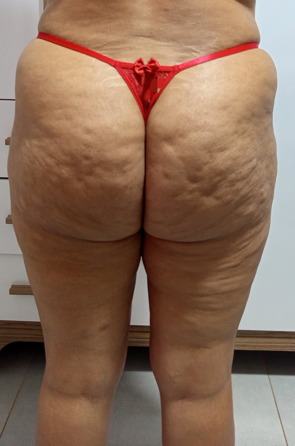 Celulite do bundao da esposa