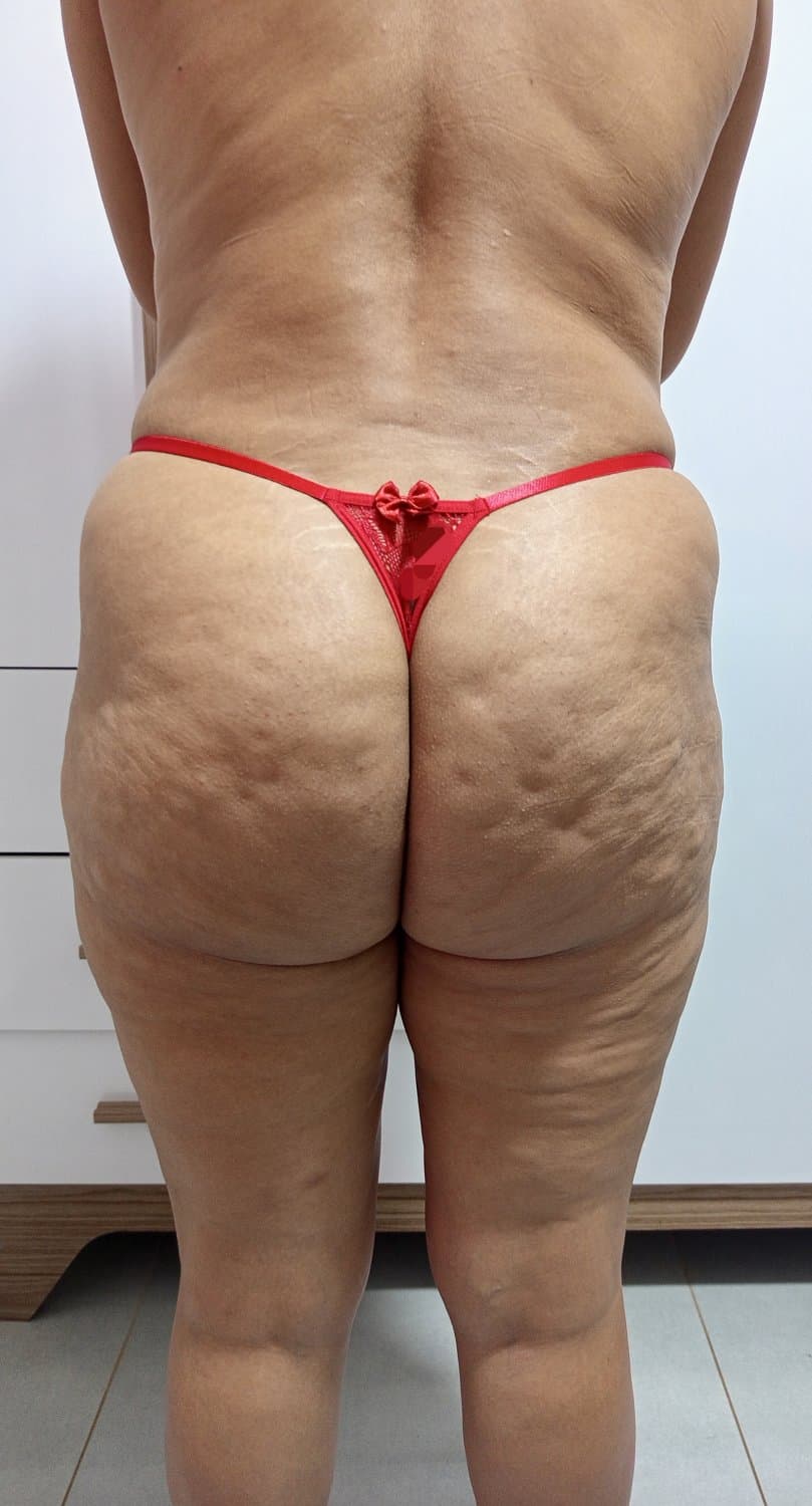 Celulite da esposa (pedidos)