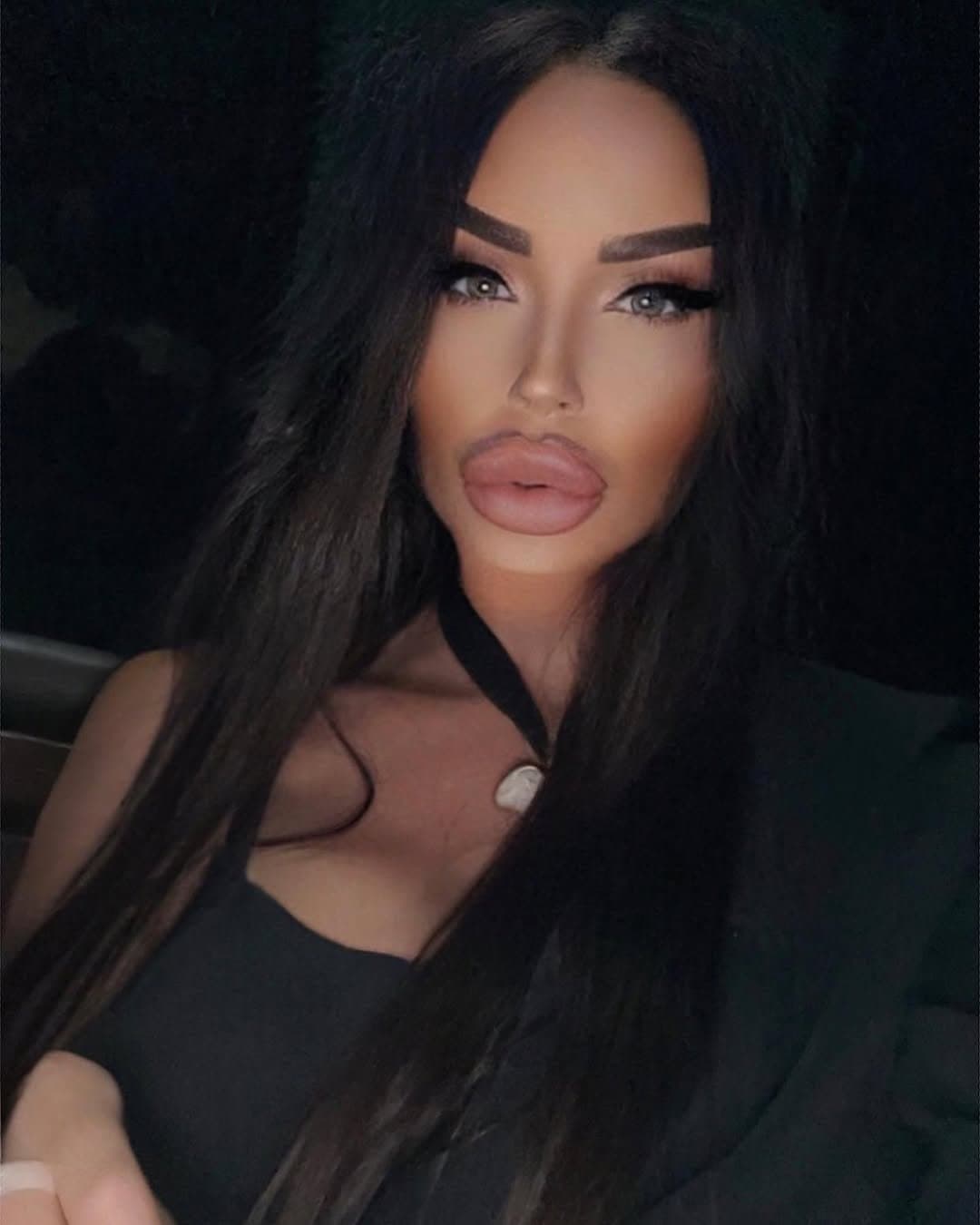 Huge Bimbo Duck Lips