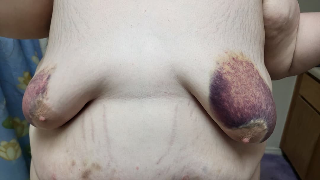 Heavy BDSM Brusing Over A Week