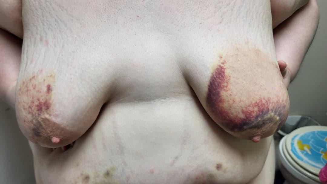 Heavy BDSM Brusing Over A Week