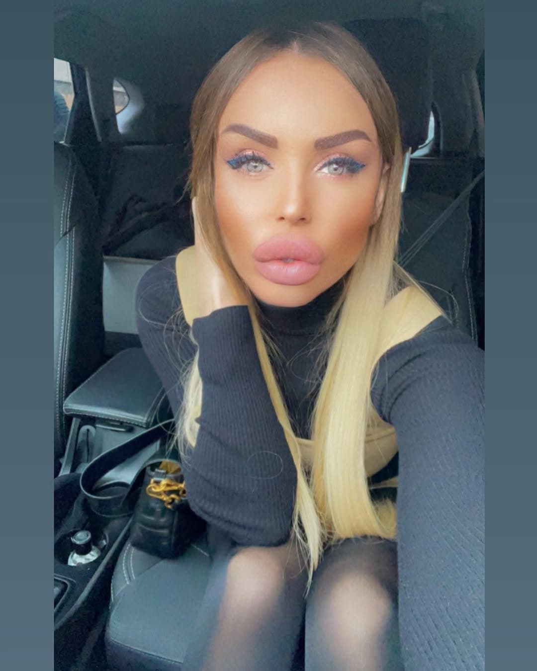 Huge Bimbo Duck Lips