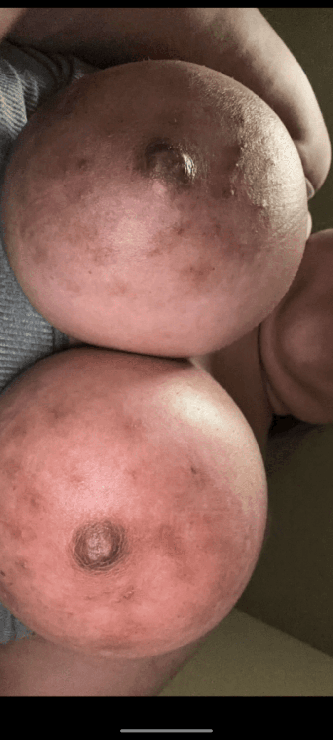 Click to view full size Large Areolas