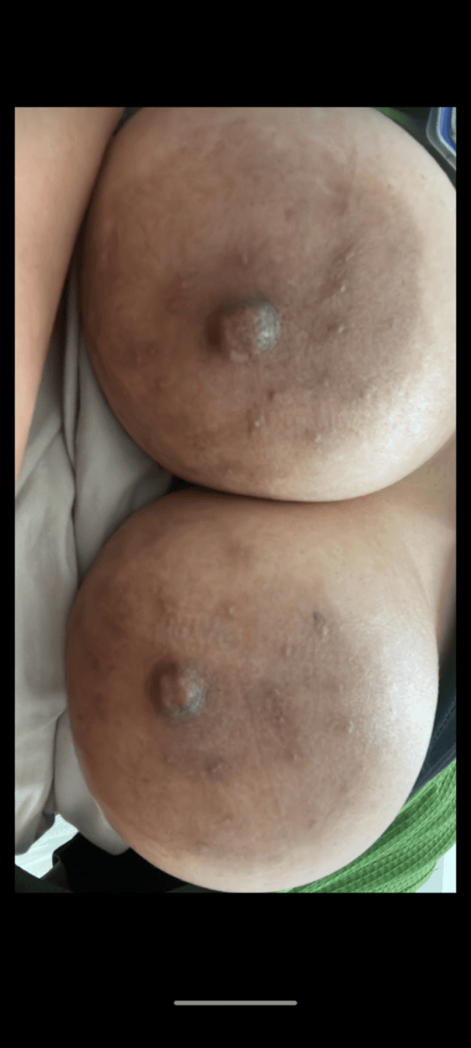 Click to view full size Large Areolas