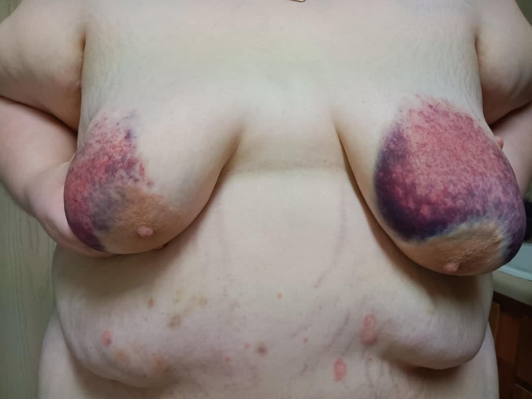 Heavy BDSM Brusing Over A Week