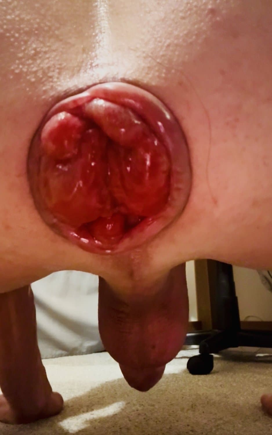 Whore extreme fisting and prolapse ?