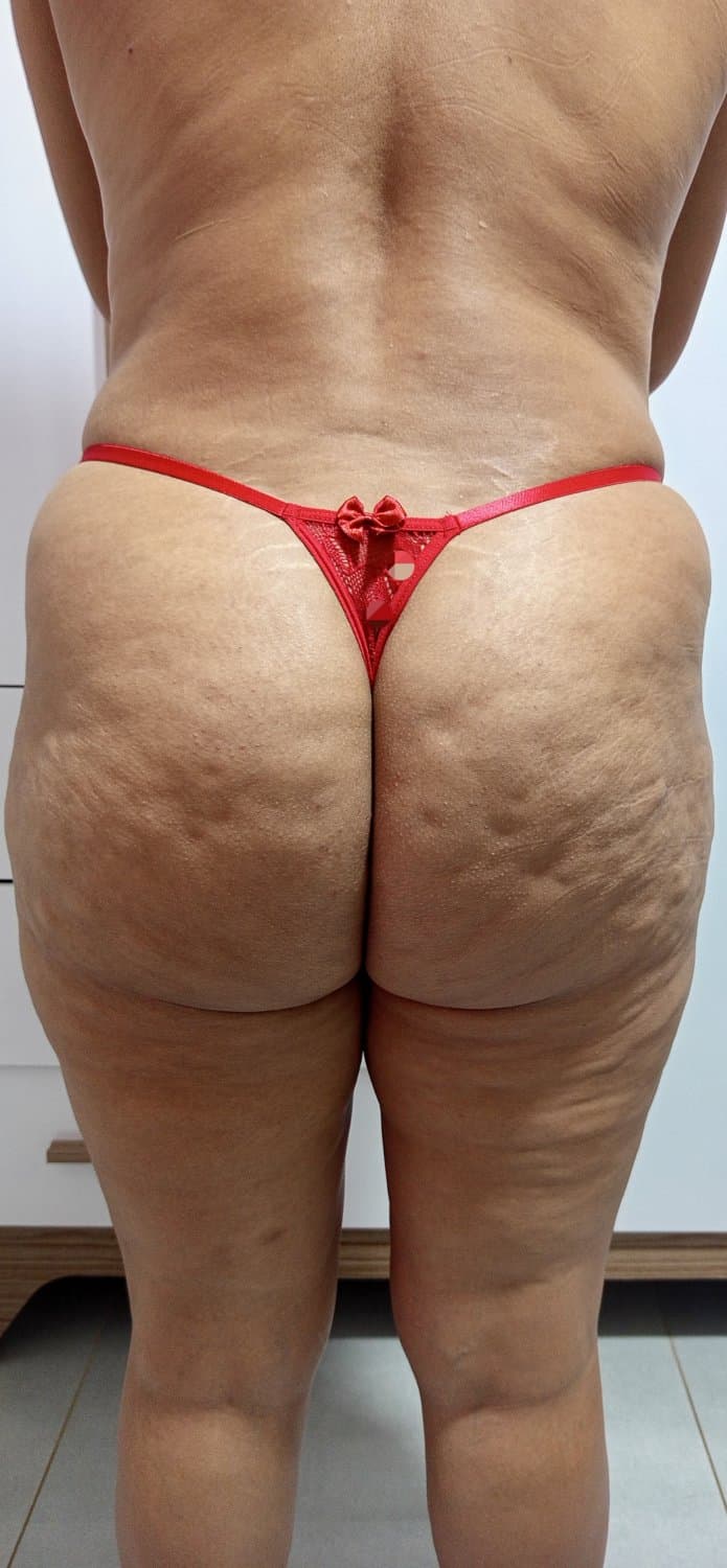 Celulite do bundao da esposa