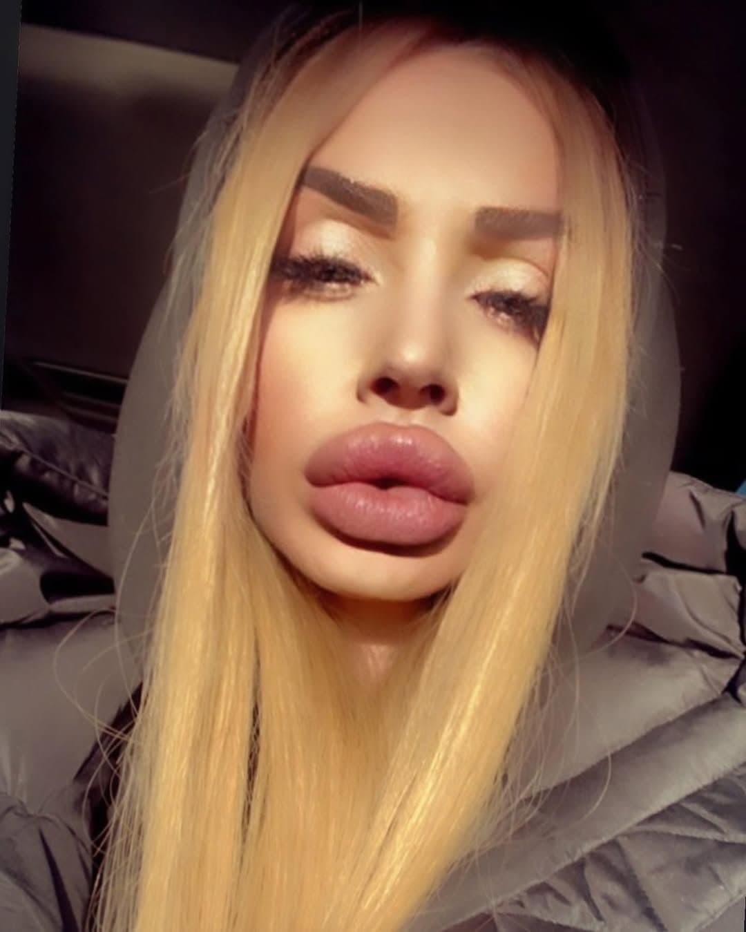 Huge Bimbo Duck Lips
