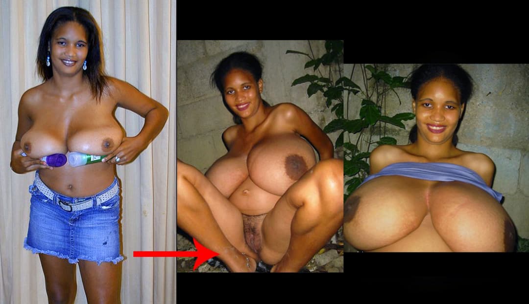 Click to view full size Natasha during Pre-reduction & Pregnancy ?❤️